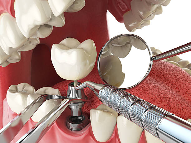 Best Emergency Dentist for Lost Fillings or Crowns in Conway, FL